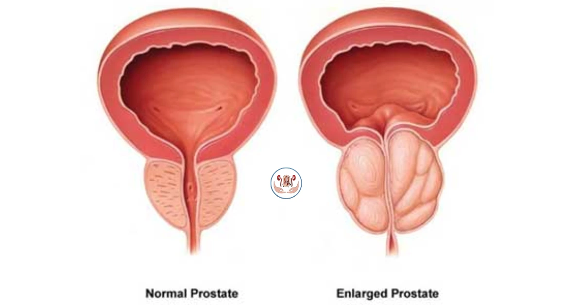 Advances in laser therapy for treating enlarged prostate (BPH)| Dr. Vipin Sharma | Urologist in Indore