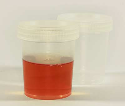 Kidney Stones Treatment in Indore | Dr. Vipin Sharma Blood in urine, Dr. Vipin Sharma, best urologist in Indore