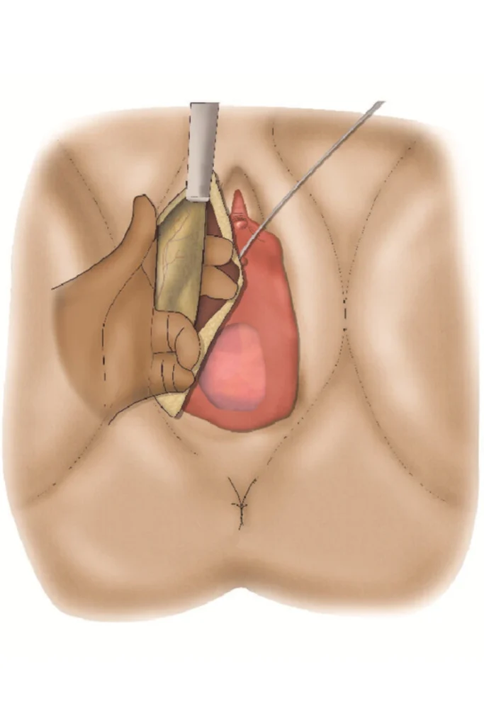 female urethroplasty, Dr. Vipin Sharma, best urologist in Indore