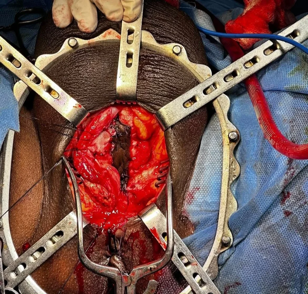 Urethroplasty Surgery Cost in Indore, Best Urologist in Indore, Dr Vipin Sharma Urologist Indore, Urethral Stricture Treatment in Indore, re, Urethral Repair Surgery Indore, Expert Urologist in Indore, Urethroplasty Recovery, Urethral Surgery Specialist, Urethral Stricture Surgery, Urinary Health Treatment Indore, Urethroplasty Treatment Cost, Best Urology Care in Indore, Urethroplasty Consultation Indore. Urethroplasty Surgery Indore, Urologist Doctor in Indore, Urinary Problems Treatment Indore, Reconstructive Urology Indore, Male Urology Specialist Indore, Advanced Urology Treatment Indore, Urethral Reconstruction Surgery, Urethral Stricture Specialist Indore, Urology Hospital in Indore, Urine Flow Problem Treatment, Laser Urology Treatment Indore, Urethroplasty Procedure Cost, Best Doctor for Urethroplasty in Indore, Urinary Tract Treatment Indore, Stricture Urethra Surgery Cost, Urinary Disorder Treatment Indore, Urology Surgeon in Indore.