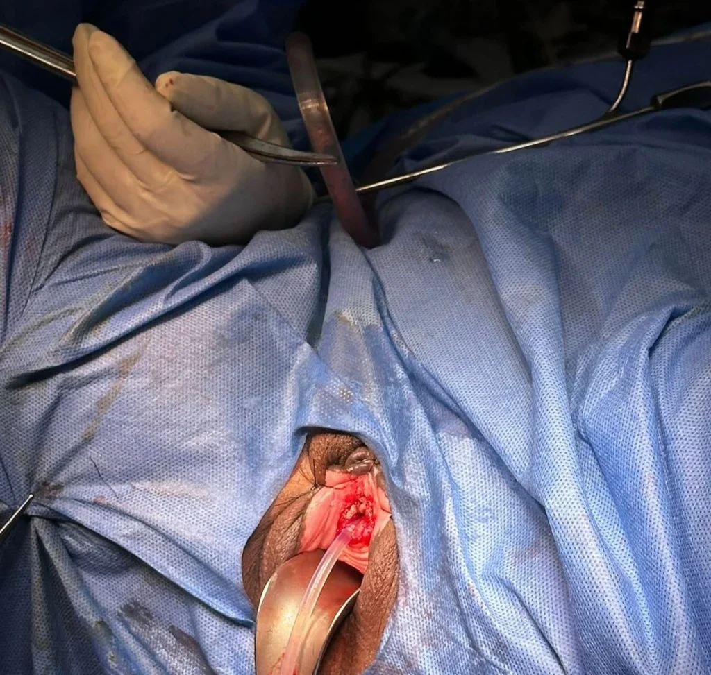 Urethroplasty Surgery Cost in Indore, Best Urologist in Indore, Dr Vipin Sharma Urologist Indore, Urethral Stricture Treatment in Indore, re, Urethral Repair Surgery Indore, Expert Urologist in Indore, Urethroplasty Recovery, Urethral Surgery Specialist, Urethral Stricture Surgery, Urinary Health Treatment Indore, Urethroplasty Treatment Cost, Best Urology Care in Indore, Urethroplasty Consultation Indore. Urethroplasty Surgery Indore, Urologist Doctor in Indore, Urinary Problems Treatment Indore, Reconstructive Urology Indore, Male Urology Specialist Indore, Advanced Urology Treatment Indore, Urethral Reconstruction Surgery, Urethral Stricture Specialist Indore, Urology Hospital in Indore, Urine Flow Problem Treatment, Laser Urology Treatment Indore, Urethroplasty Procedure Cost, Best Doctor for Urethroplasty in Indore, Urinary Tract Treatment Indore, Stricture Urethra Surgery Cost, Urinary Disorder Treatment Indore, Urology Surgeon in Indore.